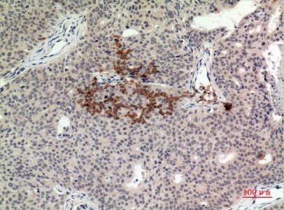 Fig.2. Immunohistochemical analysis of paraffin-embedded human-Breast-cancer, antibody was diluted at 1:100.
