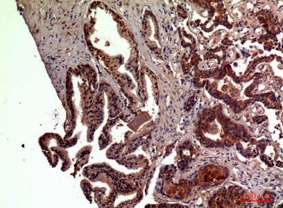 Fig.2. Immunohistochemical analysis of paraffin-embedded human-prostate-cancer, antibody was diluted at 1:100.
