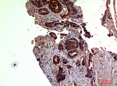 Fig.3. Immunohistochemical analysis of paraffin-embedded human-prostate-cancer, antibody was diluted at 1:100.