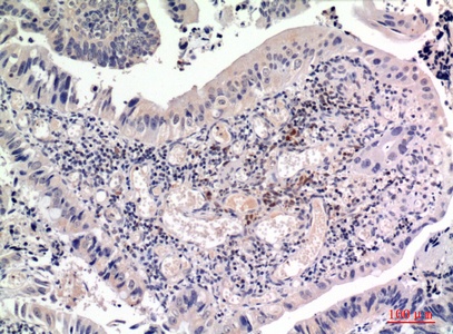 Fig.2. Immunohistochemical analysis of paraffin-embedded human-colon-cancer, antibody was diluted at 1:100.