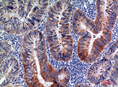 Fig.2. Immunohistochemical analysis of paraffin-embedded human-colon-cancer, antibody was diluted at 1:100.