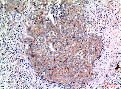 Fig.3. Immunohistochemical analysis of paraffin-embedded human-breast-cancer, antibody was diluted at 1:100.