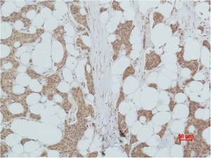 Fig.2. Immunohistochemical analysis of paraffin-embedded human Breast caricnoma using PI 3-kinase p85α Polyclonal Antibody.