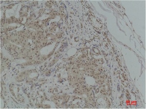 Fig.2. Immunohistochemical analysis of paraffin-embedded Human Breast Carcinoma using TGFβ1 Polyclonal Antibody.