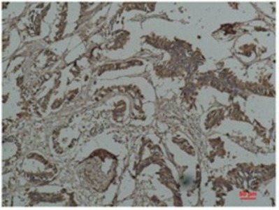 Fig.2. Immunohistochemical analysis of paraffin-embedded Human Breast Caricnoma using HSP27Mouse mAb diluted at 1:200.