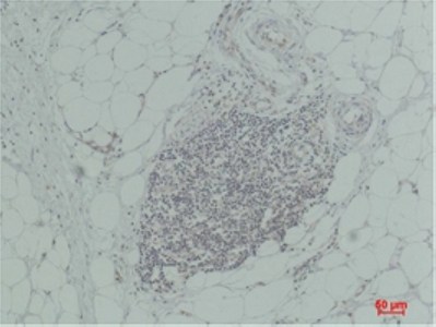Fig.4. Immunohistochemical analysis of paraffin-embedded Human Breast Carcinoma using TNF aRabbit pAb diluted at 1:200.