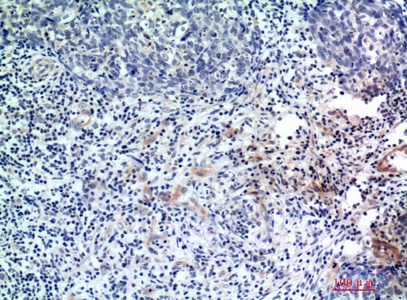 Fig.2. Immunohistochemical analysis of paraffin-embedded human-breast-cancer, antibody was diluted at 1:200.