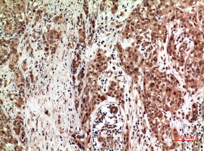 Fig.2. Immunohistochemical analysis of paraffin-embedded human-breast-cancer, antibody was diluted at 1:100.