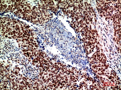 Fig.2. Immunohistochemical analysis of paraffin-embedded human-breast-cancer, antibody was diluted at 1:200.