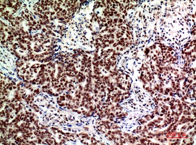 Fig.3. Immunohistochemical analysis of paraffin-embedded human-breast-cancer, antibody was diluted at 1:200.