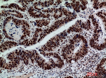Fig.3. Immunohistochemical analysis of paraffin-embedded human-colont-cancer, antibody was diluted at 1:200.