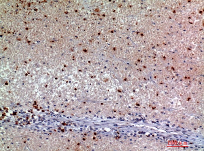 Fig.2. Immunohistochemical analysis of paraffin-embedded human-kidneycancer, antibody was diluted at 1:200.