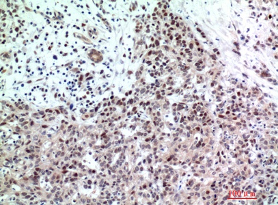 Fig.2. Immunohistochemical analysis of paraffin-embedded human-breast-cancer, antibody was diluted at 1:200.