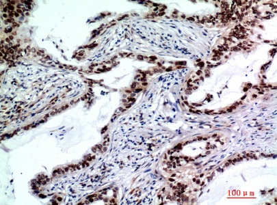 Fig.3. Immunohistochemical analysis of paraffin-embedded human-lungcancer, antibody was diluted at 1:200.