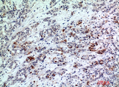 Fig.2. Immunohistochemical analysis of paraffin-embedded human-breast-cancer, antibody was diluted at 1:200.