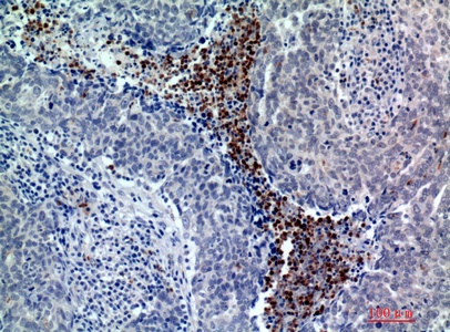 Fig.3. Immunohistochemical analysis of paraffin-embedded human-breast-cancer, antibody was diluted at 1:200.