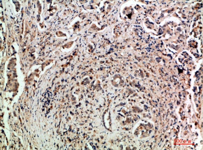 Fig.2. Immunohistochemical analysis of paraffin-embedded human-breast-cancer, antibody was diluted at 1:200.