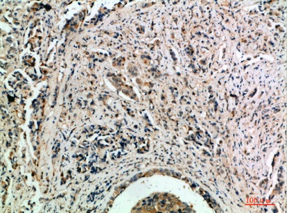 Fig.3. Immunohistochemical analysis of paraffin-embedded human-breast-cancer, antibody was diluted at 1:200.