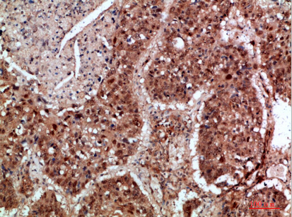 Fig.3. Immunohistochemical analysis of paraffin-embedded human-lung-cancer, antibody was diluted at 1:200.
