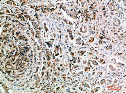 Fig.3. Immunohistochemical analysis of paraffin-embedded human-breast-cancer, antibody was diluted at 1:200.