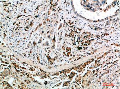 Fig.4. Immunohistochemical analysis of paraffin-embedded human-breast-cancer, antibody was diluted at 1:200.