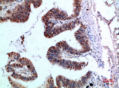Fig.2. Immunohistochemical analysis of paraffin-embedded human-colon-cancer, antibody was diluted at 1:200.