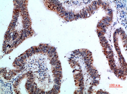 Fig.3. Immunohistochemical analysis of paraffin-embedded human-colon-cancer, antibody was diluted at 1:200.
