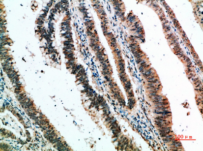 Fig.2. Immunohistochemical analysis of paraffin-embedded human-colon-cancer, antibody was diluted at 1:200.