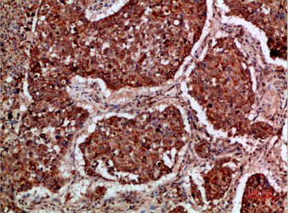Fig.2. Immunohistochemical analysis of paraffin-embedded human-lung-cancer, antibody was diluted at 1:200.