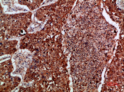 Fig.3. Immunohistochemical analysis of paraffin-embedded human-lung-cancer, antibody was diluted at 1:200.