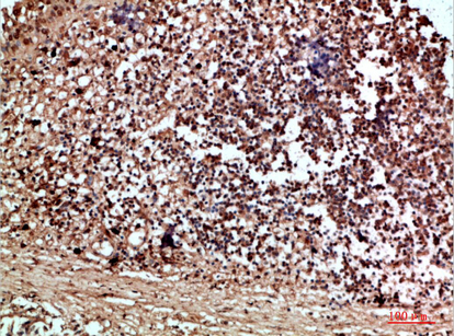 Fig.2. Immunohistochemical analysis of paraffin-embedded human-thyroid, antibody was diluted at 1:200.