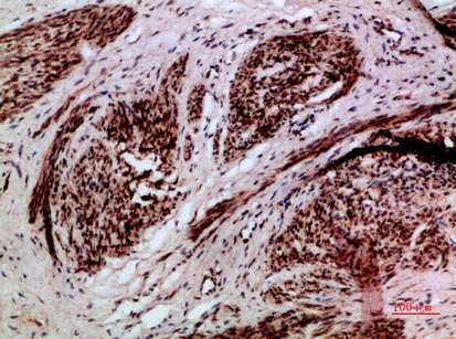 Fig.2. Immunohistochemical analysis of paraffin-embedded human-cervical-cancer, antibody was diluted at 1:200.