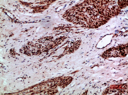 Fig.3. Immunohistochemical analysis of paraffin-embedded human-cervical-cancer, antibody was diluted at 1:200.