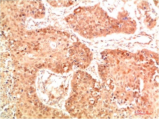 Fig.1. Immunohistochemical analysis of paraffin-embedded Human Lung Carcinoma Tissue using Nrf2 Rabbit pAb diluted at 1:500.