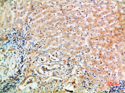 Fig.2. Immunohistochemical analysis of paraffin-embedded human-liver-cancer, antibody was diluted at 1:200.