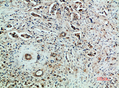 Fig.1. Immunohistochemical analysis of paraffin-embedded human-breast-cancer, antibody was diluted at 1:200.