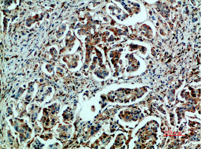 Fig.2. Immunohistochemical analysis of paraffin-embedded human-breast-cancer, antibody was diluted at 1:200.