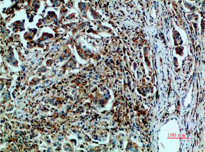 Fig.3. Immunohistochemical analysis of paraffin-embedded human-breast-cancer, antibody was diluted at 1:200.