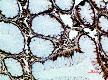 Fig.4. Immunohistochemical analysis of paraffin-embedded human-colon-cancer, antibody was diluted at 1:200.