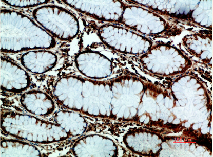Fig.5. Immunohistochemical analysis of paraffin-embedded human-colon-cancer, antibody was diluted at 1:200.