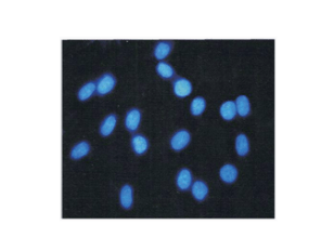 Fig. Bright blue fluorescence of Hoechst 33258 staining glioma cells (C5 cell lines) nuclear.